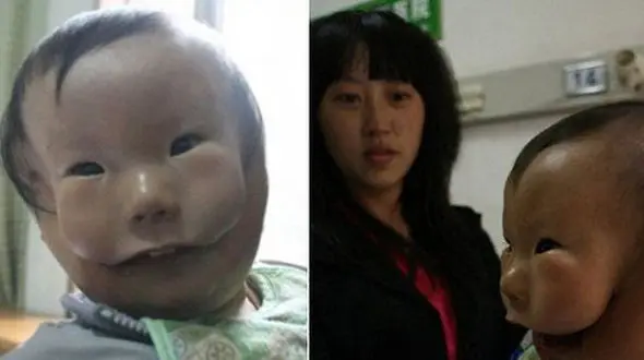 این کودک با یک نقاب بر صورت به دنیا آمد! +عکس