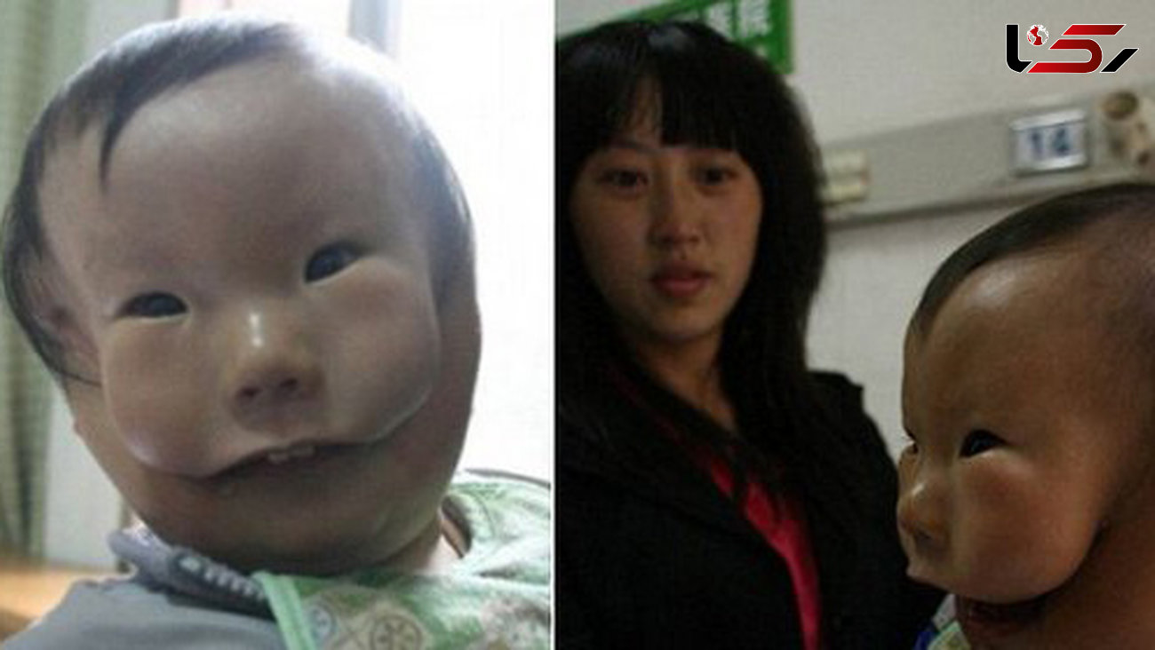 این کودک با یک نقاب بر صورت به دنیا آمد! +عکس
