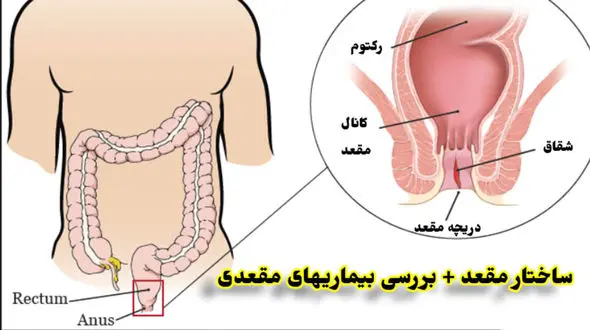 انواع بیماری های مقعدی را بشناسید + روش درمان با جدول