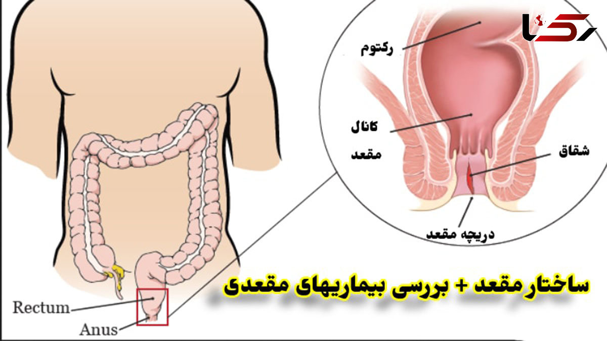 انواع بیماری های مقعدی را بشناسید + روش درمان با جدول