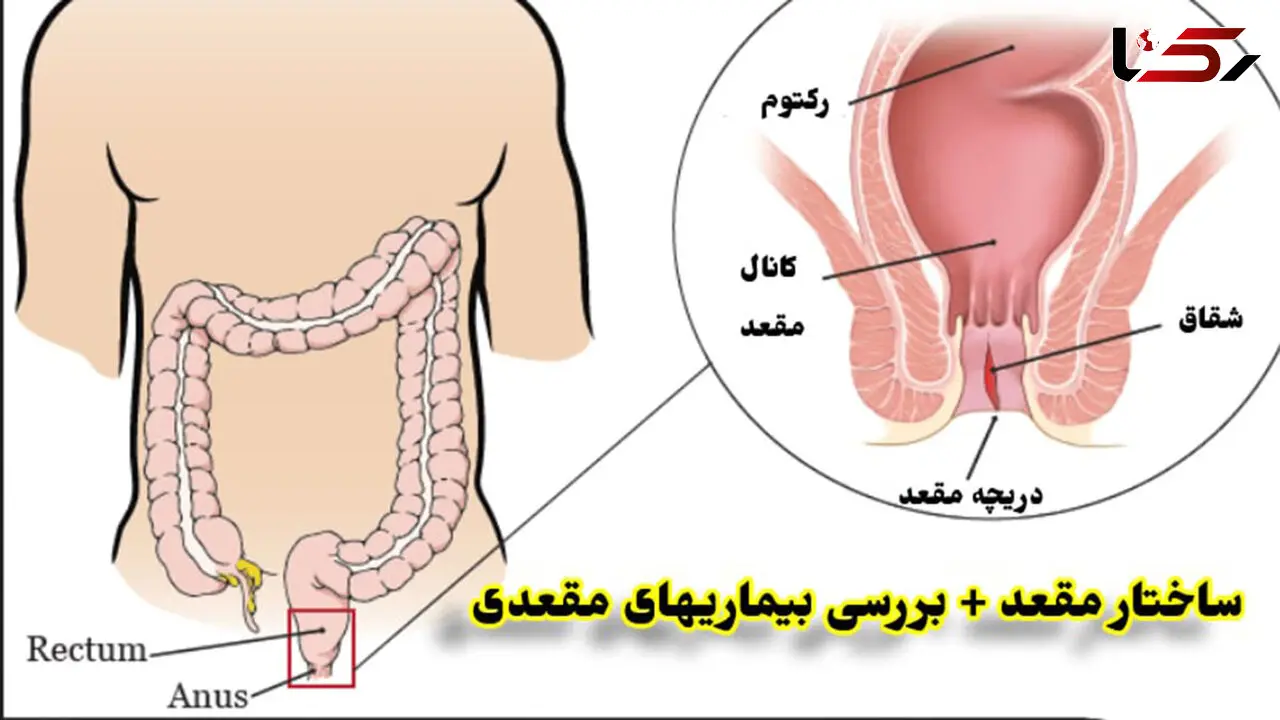 انواع بیماری های مقعدی را بشناسید + روش درمان با جدول
