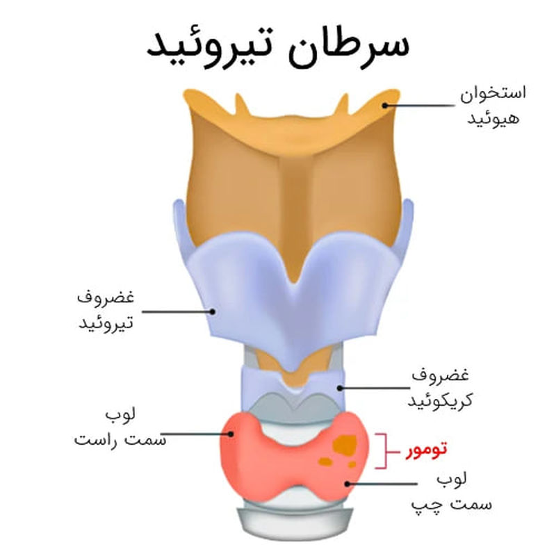 سرطان تیروئید