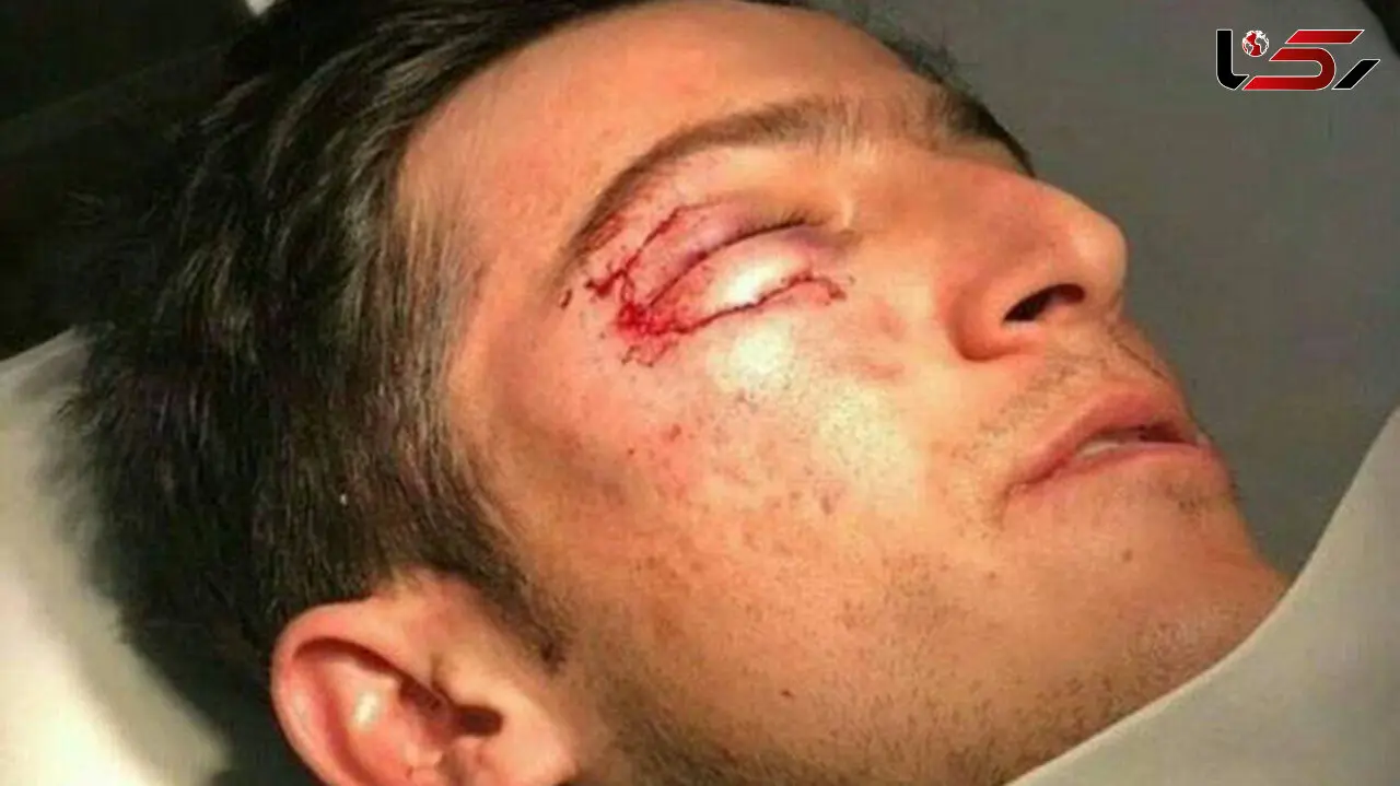 
سردار آزمون، قبل و بعد از عمل +تصاویر
