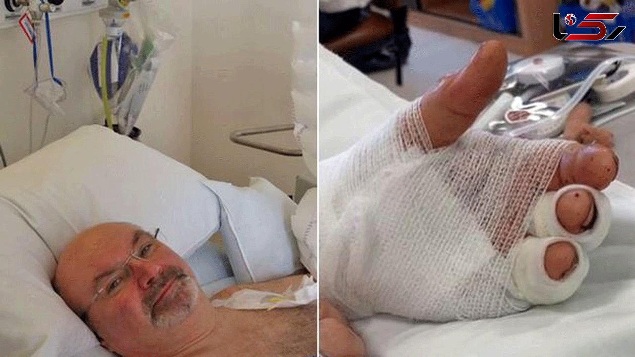 Doctors re-attach man's hand after it was chopped off by machine in incredible surgery