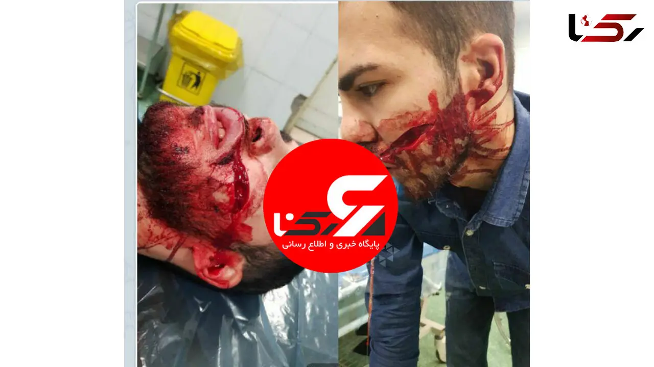 عکس از شکافته شدن صورت یک جوان تهرانی با چاقوی زورگیران خشن