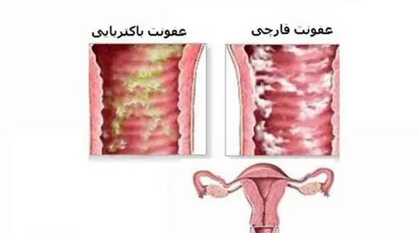 عفونت زنانه ای که مخفیانه می تازد 