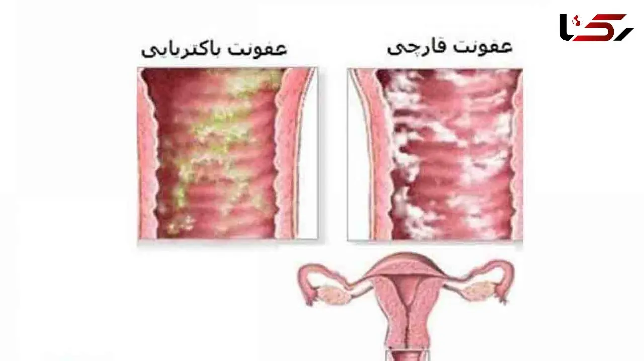 عفونت زنانه ای که مخفیانه می تازد 