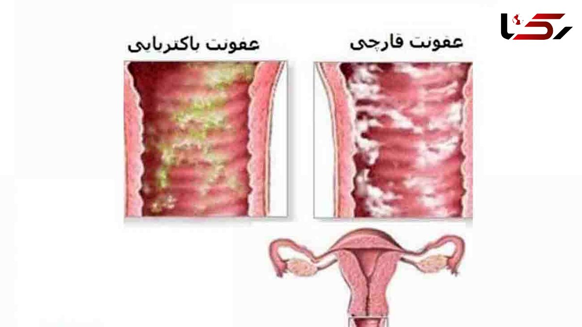 عفونت زنانه ای که مخفیانه می تازد 