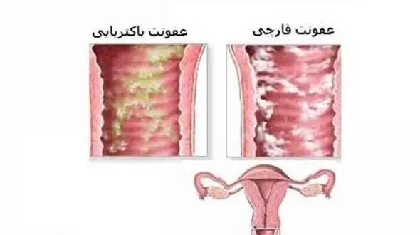 عفونت زنانه ای که مخفیانه می تازد 