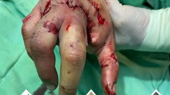  نخستین پیوند عضو قطع شده از کف دست