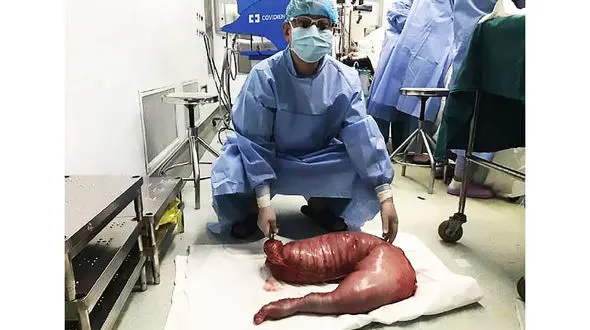 13 کیلو مدفوع در روده یک مرد جاخوش کرده بود+ عکس