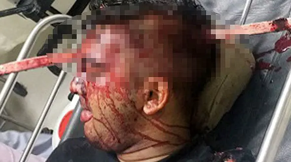 فرو رفتن میله آهنی در جمجمه احمد / او زنده ماند + عکس باورنکردنی