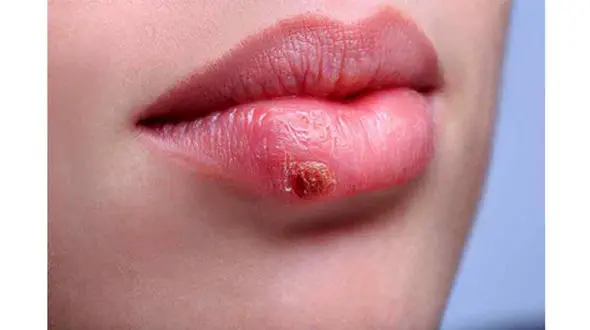 چند درمان خانگی برای تبخال