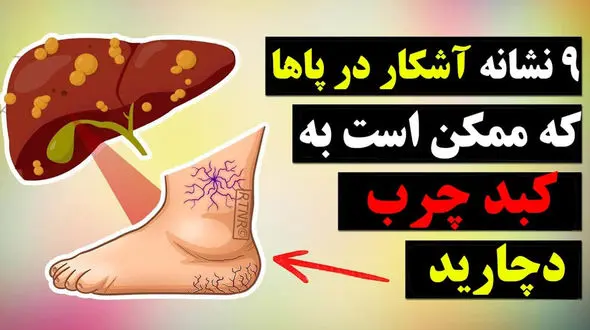تشخیص علائم کبد چرب از روی پا + فیلم