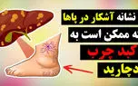 تشخیص علائم کبد چرب از روی پا + فیلم