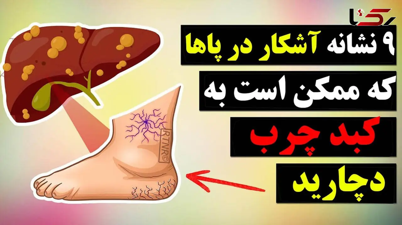 تشخیص علائم کبد چرب از روی پا + فیلم