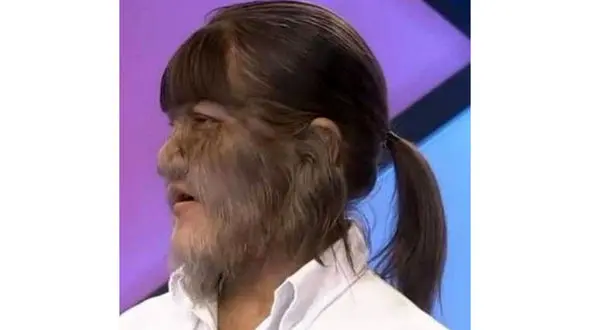 ازدواج باور نکردنی پرموترین دختر دنیا/ثبت رکورد گینسی به خاطر موهای زائد صورت +تصاویر