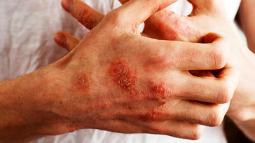 چرا دست ها پوسته پوسته می شوند؟ + راه های درمان