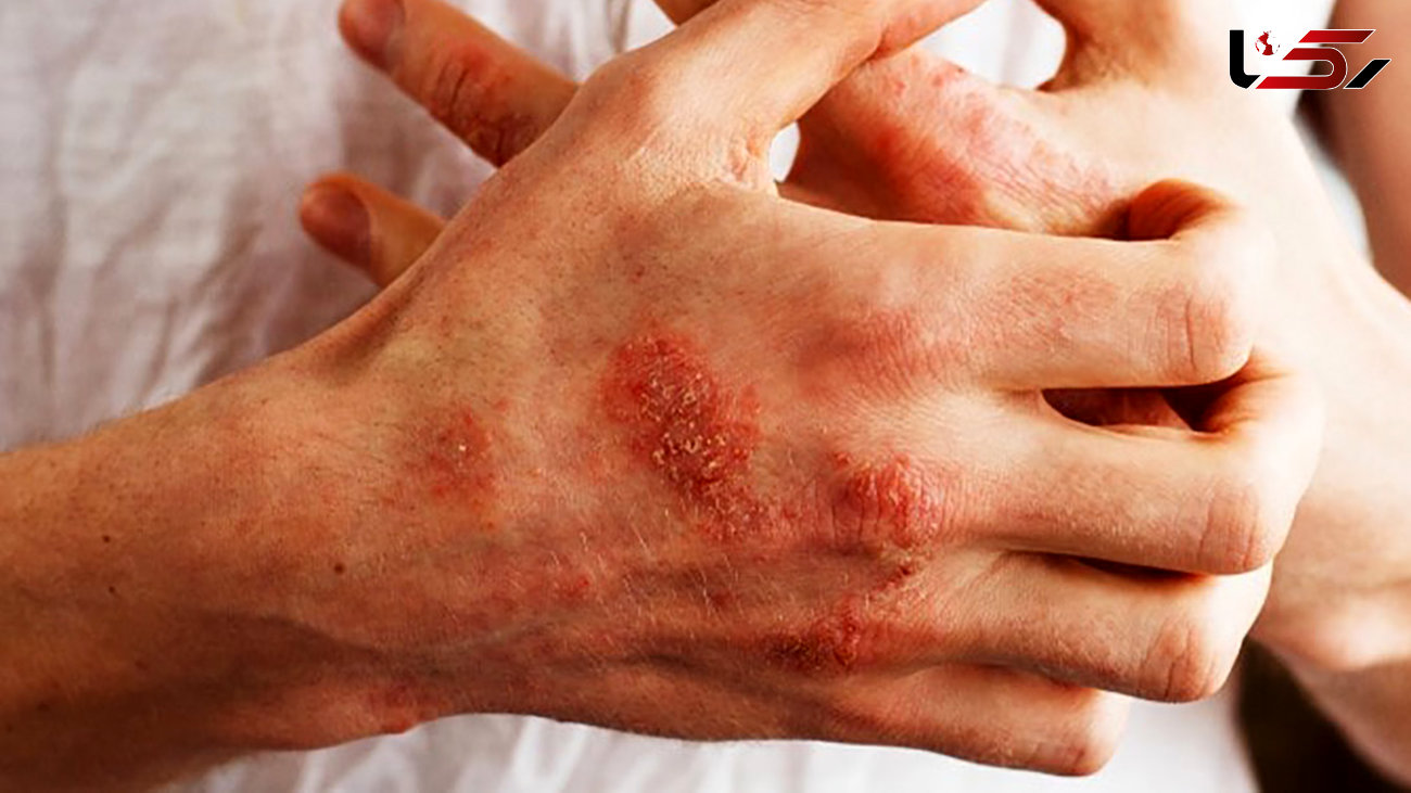 چرا دست ها پوسته پوسته می شوند؟ + راه های درمان
