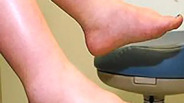 راهکارهای طلایی برای تسکین ورم پا