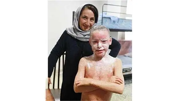 تلخندهای خواهر و برادر با بیماری ماهیاک/این بیماری پوستی زندگی را غیرطبیعی می کند