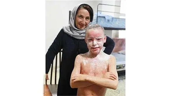 تلخندهای خواهر و برادر با بیماری ماهیاک/این بیماری پوستی زندگی را غیرطبیعی می کند