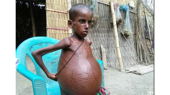 بیماری عجیب پسر 7 ساله هندی+تصویر