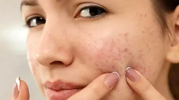 علائم هشداردهنده پوست: از جوش تا بیماری‌ های جدی