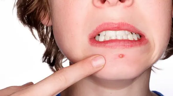 بهترین درمان جوش ها در دوران بلوغ چیست؟