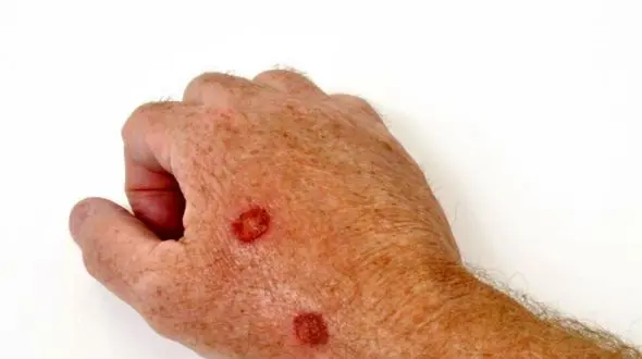 تشخیص درست: نیش حشرات یا سرطان پوست؟ علائم را بررسی کنید