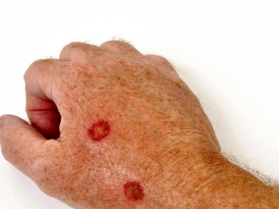 تشخیص درست: نیش حشرات یا سرطان پوست؟ علائم را بررسی کنید