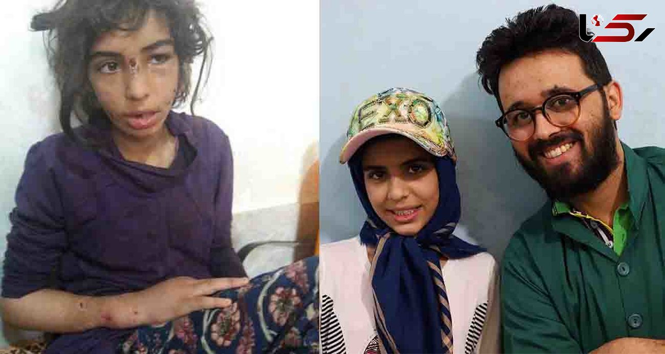 بازگشت لبنخد به صورت فاطمه، دختر شکنجه دیده ماهشهری + عکس