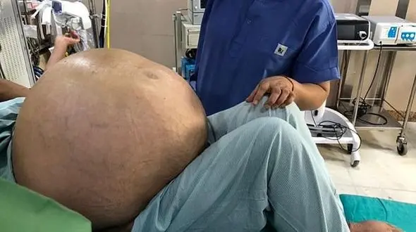 عمل موفق بیرون آوردن بزرگ ترین تومور تخمدانی دنیا به وزن ۵۱ کیلوگرم + عکس