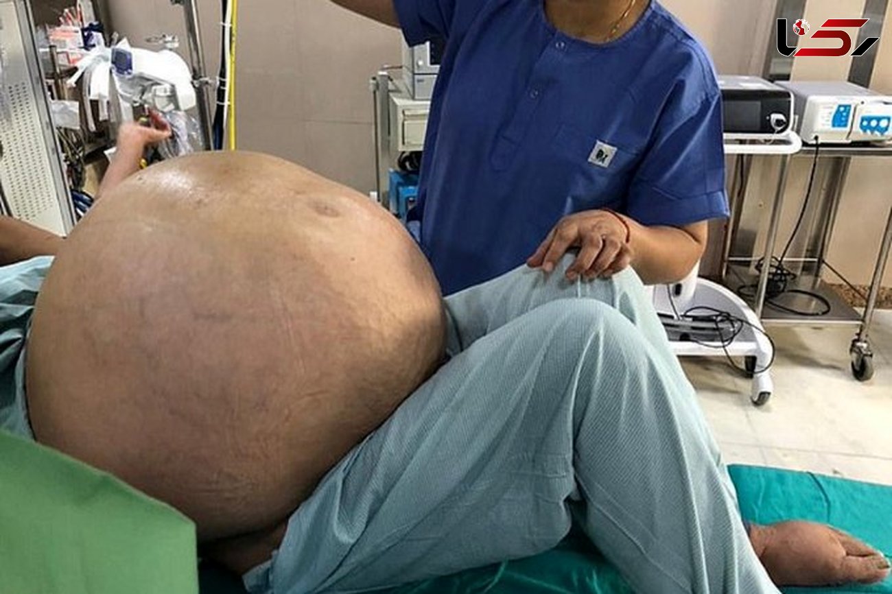 عمل موفق بیرون آوردن بزرگ ترین تومور تخمدانی دنیا به وزن ۵۱ کیلوگرم + عکس