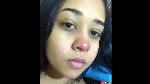 پیرسینگ گذاشتن روی بینی دختر جوان را فلج کرد+عکس