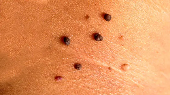 فوت و فن از بین بردن خال های گوشتی