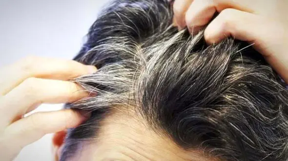 انواع شوره‌ سر و دلایل ایجاد