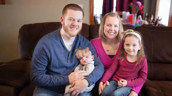 کودک عجیبی که جمجمه ندارد + تصاویر