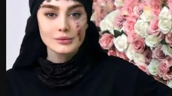 فیلم پاک کردن تتوهای صورت و بدن سحر قریشی ! /  خانم لیزرکار فاش کرد