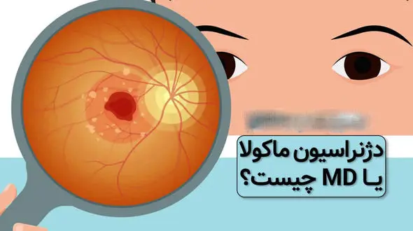 ماکولار چیست؟ / اختلالات ماکولار در چشم و بینایی