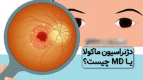 ماکولار چیست؟ / اختلالات ماکولار در چشم و بینایی