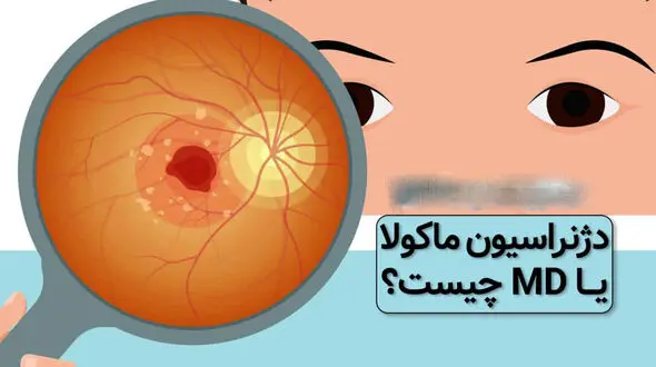 ماکولار چیست؟ / اختلالات ماکولار در چشم و بینایی