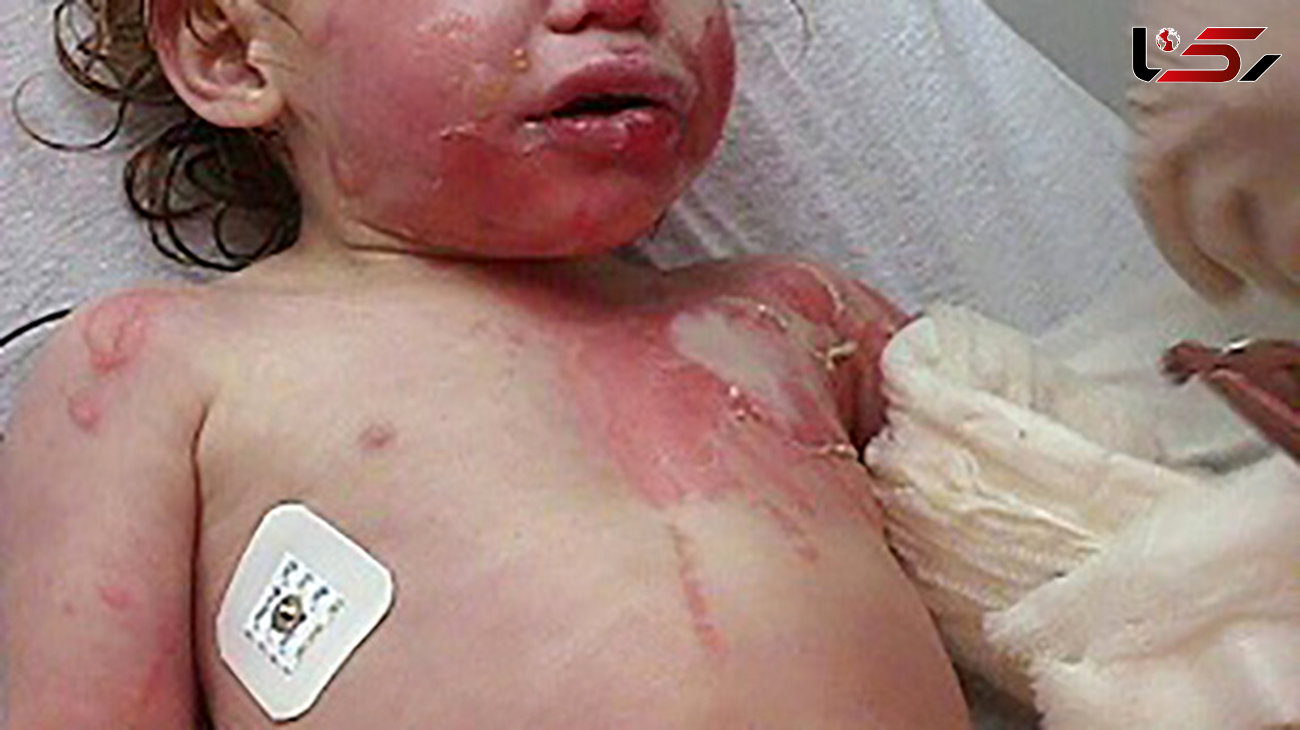 نجات کودک سوخته با استفاده از پوست اهدایی 