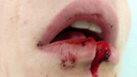 انفجار اسپری خوشبو کننده دهان دختر 17 ساله را به شدت زخمی کرد+عکس