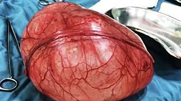 راز برآمدگی 30 سانتی زن 63 ساله در بیمارستان دهدشت فاش شد + عکس 