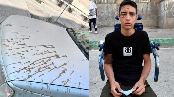 فیلم گفتگو با آخرین قربانی اسیدپاشی در تهران + جزئیات و عکس