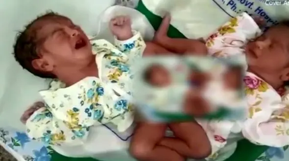 عجیب‌ترین نوزادان دوقلویی که تاکنون دیده‌اید + فیلم و عکس