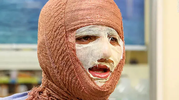 درخواست کمک برای درمان 464 کودک و زنان و مردانی که سوخته اند  