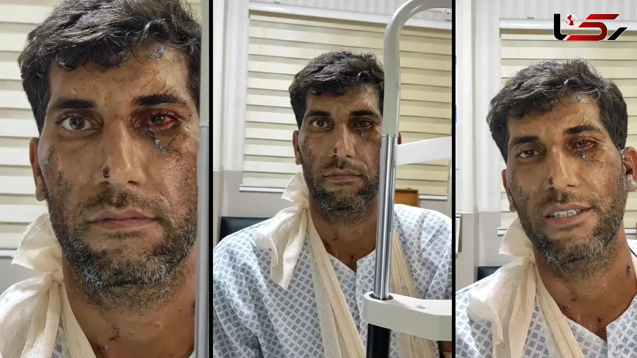 جراحی موفقیت‌آمیز چشم مجروح انفجار در بندر شهید رجایی