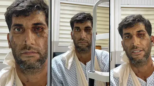 جراحی موفقیت‌آمیز چشم مجروح انفجار در بندر شهید رجایی